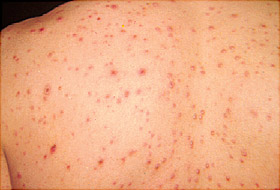 What is Chickenpox?
